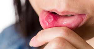 afte sau leziuni bucale, gura dureroasa, stomatita