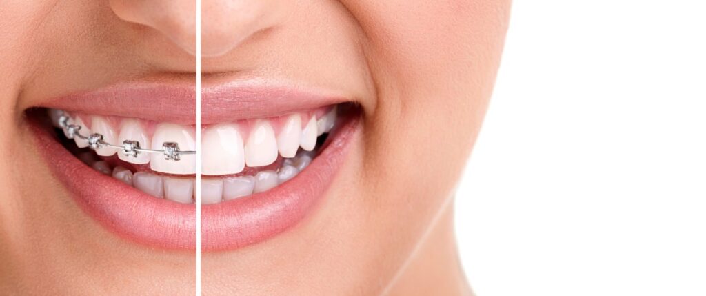 strap Reliable Than Bracket Dentar | Clinicile Trident