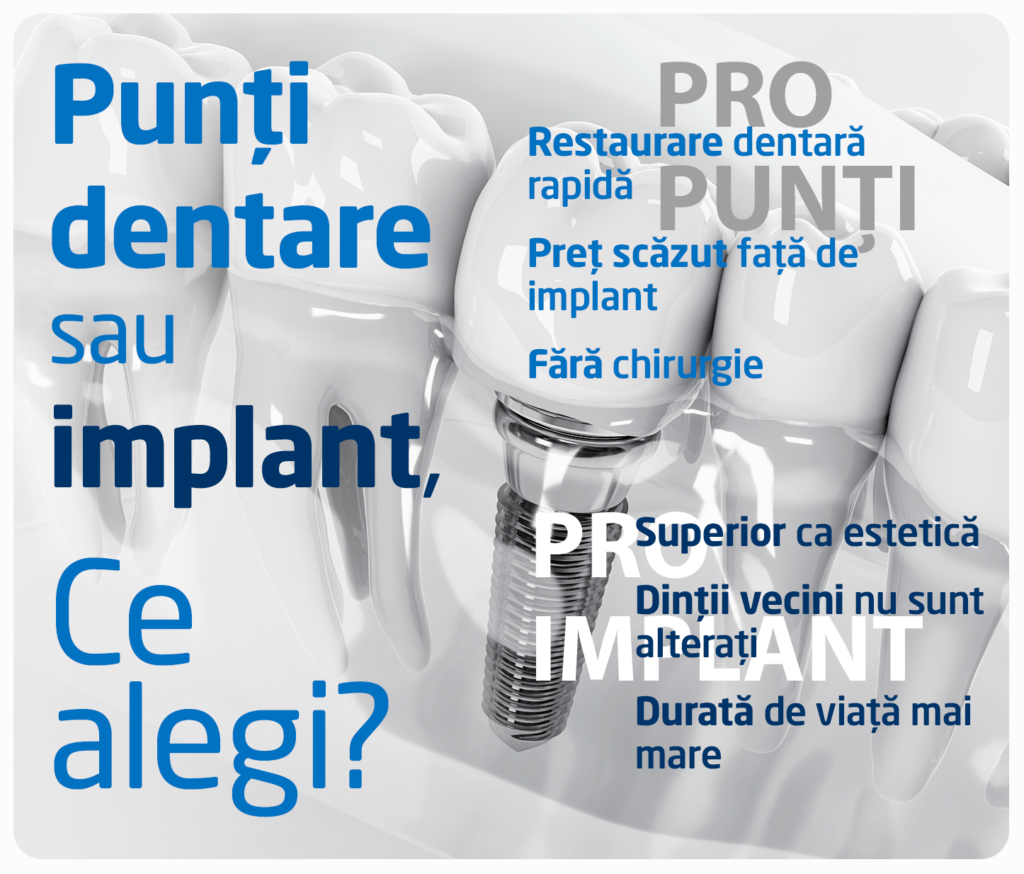 punti dentare sau implant, infografic | Clinicile Trident