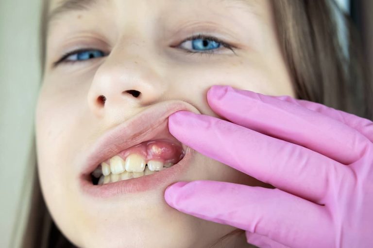 fetita cu abces gingival la controlul stomatologic