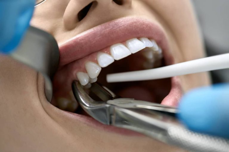 pacienta in timpul procedurii de extractie dentara