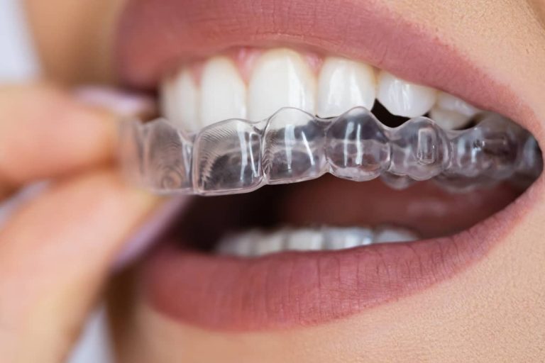 femeie fixeaza gutiere transparente pe dinti