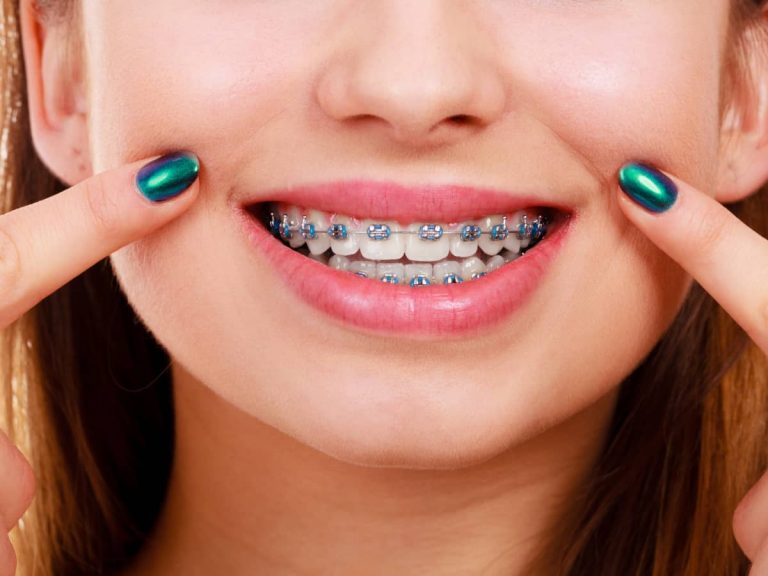tanara cu aparat dentar
