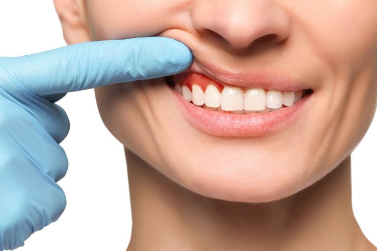 femeie tanara cu inflamație gingivala
