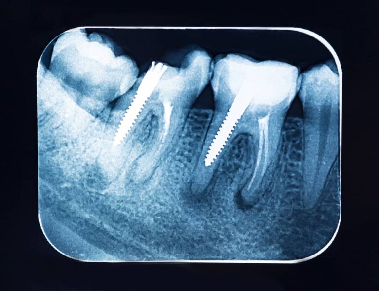 pivoti dentari evidentiati pe radiografia dentara